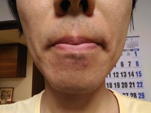 ヒゲ脱毛9日目