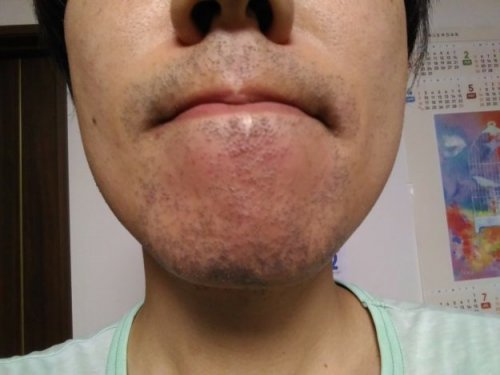 ヒゲ脱毛3日後